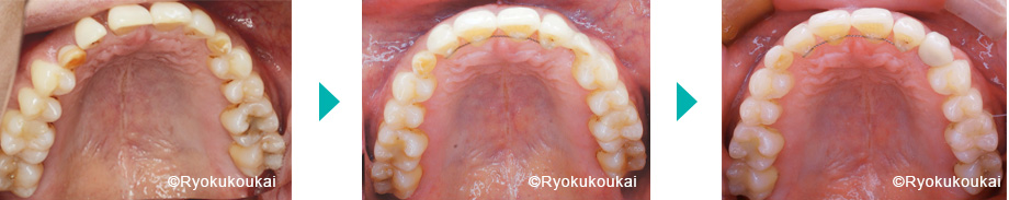 上顎　永久歯欠損　インプラント