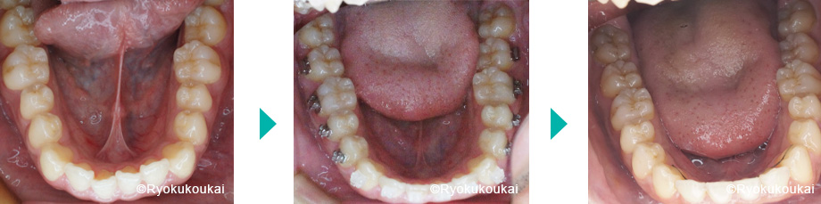 下顎　下の歯並び　ビフォーアフター