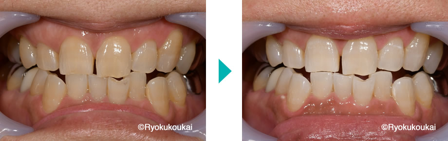 ホワイトニング術前術後