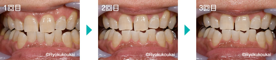 オフィスホワイトニング3回の変化