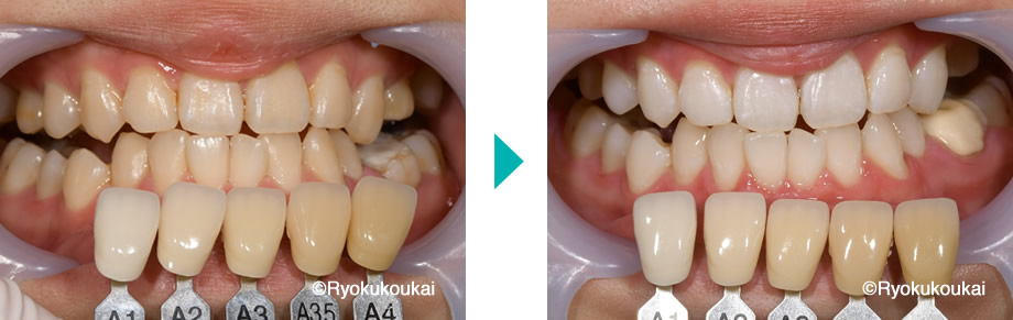 オフィスホワイトニング術前術後