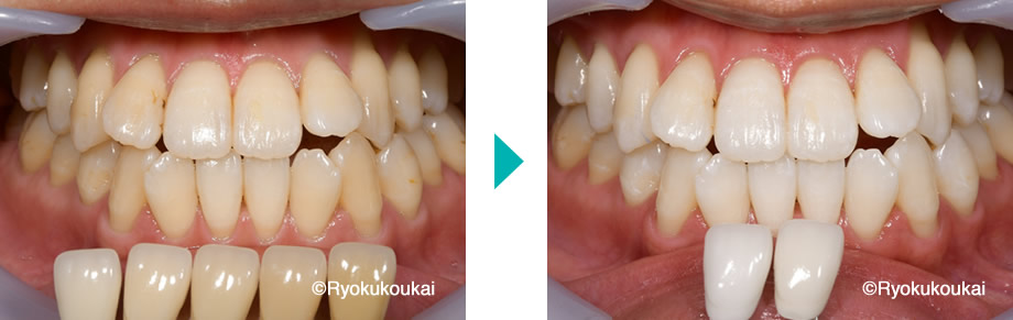 デュアルホワイトニング術前術後