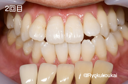 デュアルホワイトニング2回目