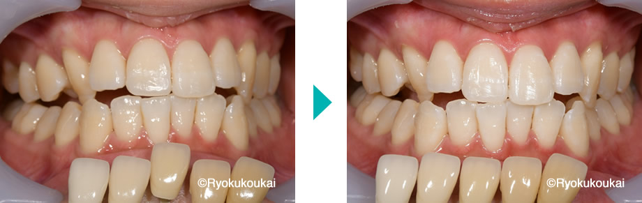 オフィスホワイトニング術前術後