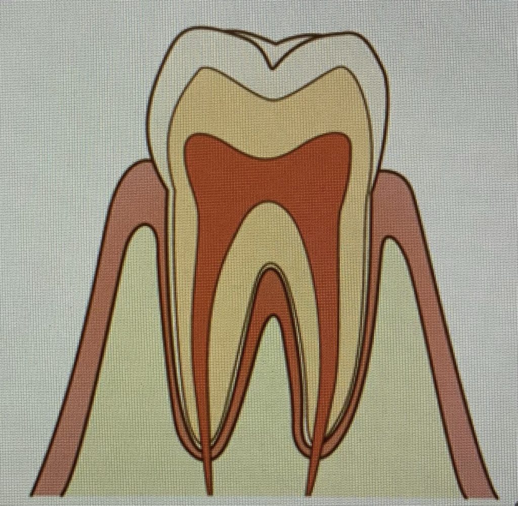 歯医者　健康な歯　虫歯のでき方