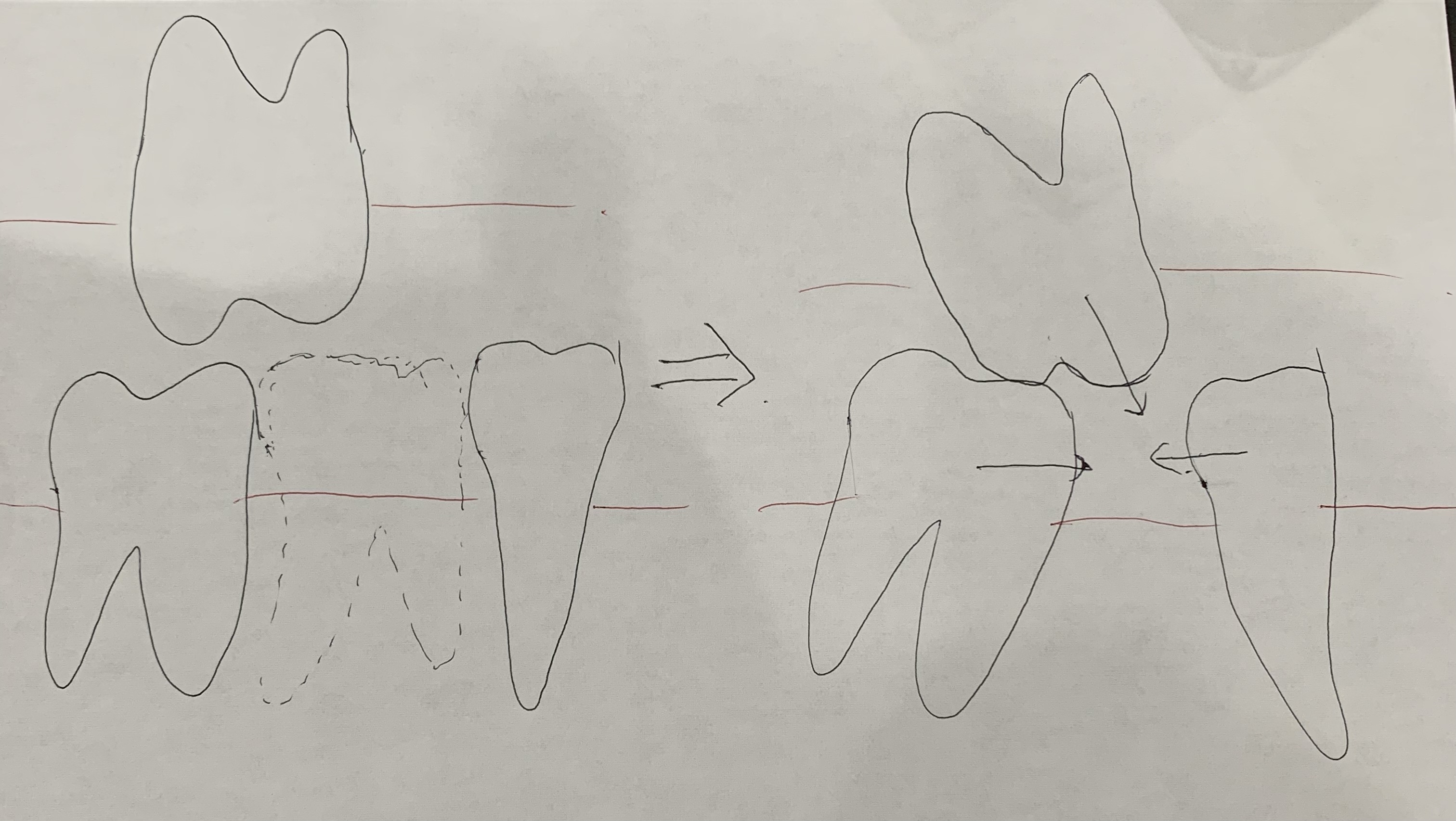 桜新町の歯医者「桜新町グリーン歯科・矯正歯科」の入れ歯•義歯治療の