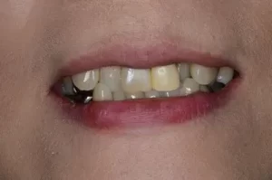 歯の黄ばみ　桜新町　歯医者