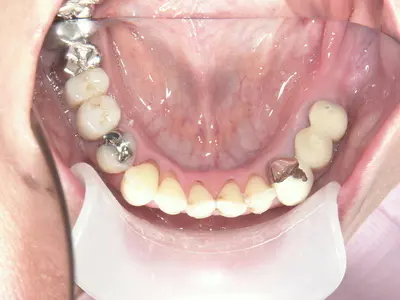 インプラント治療の実症例お見せします。 | 世田谷区桜新町 「桜新町