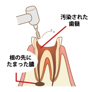根管治療　歯の根っこの治療　歯がズキズキ痛い