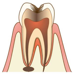 根尖病巣　乳歯　歯並び