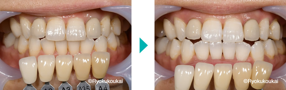 オフィスホワイトニング症例