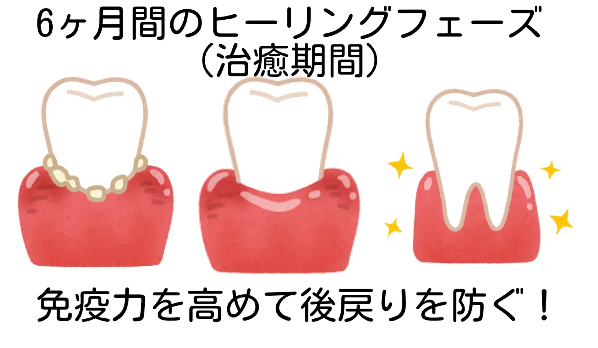 ヒーリングフェーズ　歯周病治療後の６か月間　歯周病治療