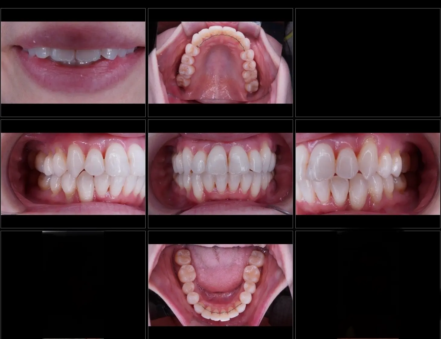 40代矯正治療アフター　八重歯治療　歯を抜かない矯正