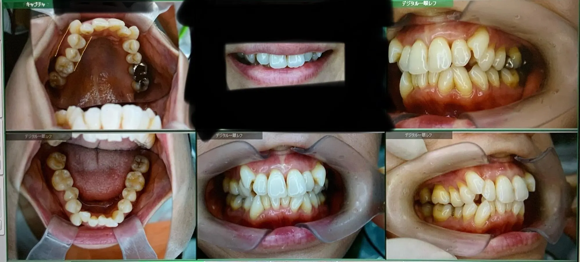 40代女性矯正ビフォー　非抜歯矯正　歯を抜かない矯正