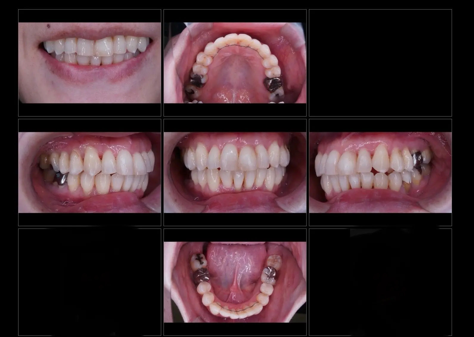 40代矯正治療アフター　出っ歯改善　非抜歯矯正