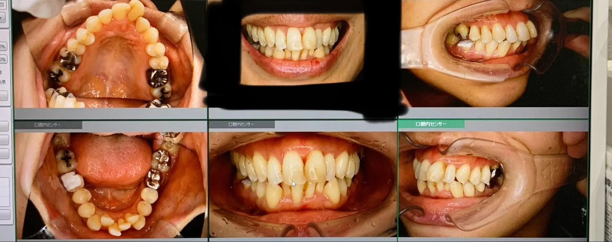 40代出っ歯矯正治療　矯正ビフォーアフター　症例写真