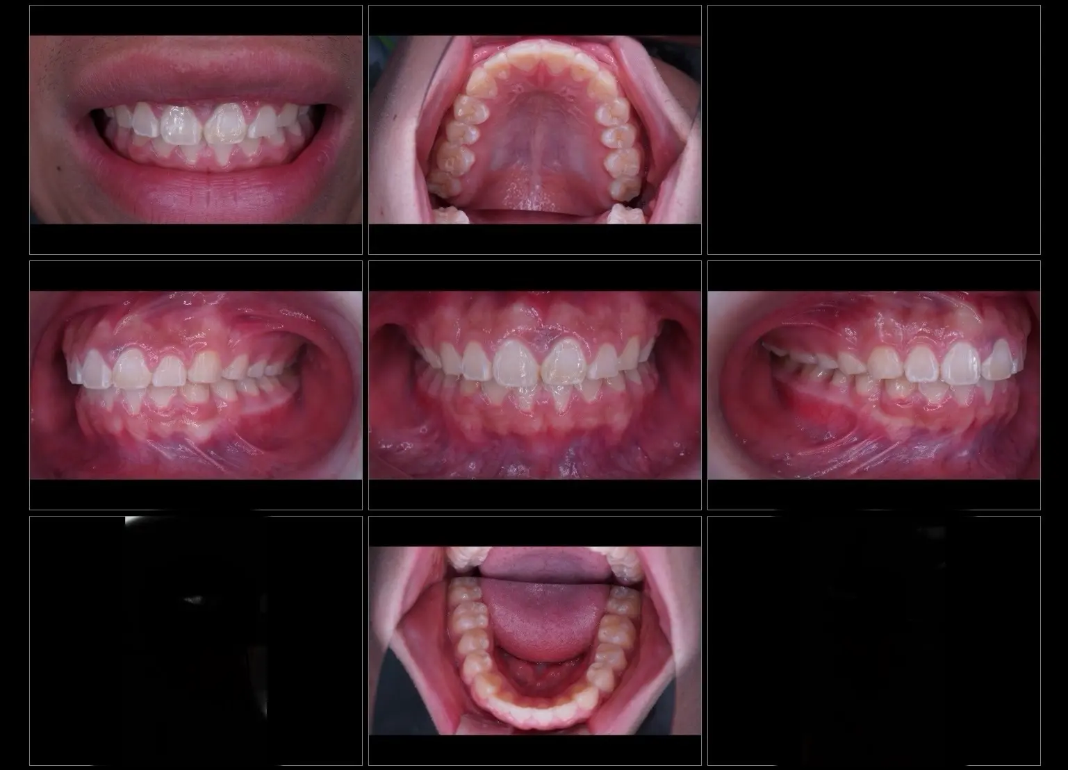 非抜歯矯正治療後　矯正ビフォーアフター　男の子症例